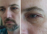 day 14 || diptych || infection